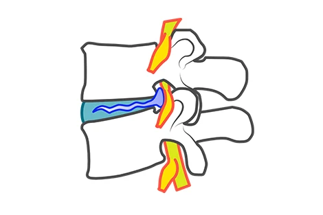 腰椎椎間板ヘルニアの説明画像