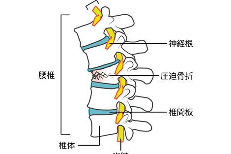 腰椎分離症の説明画像