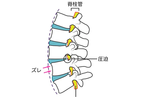 腰椎すべり症の説明画像
