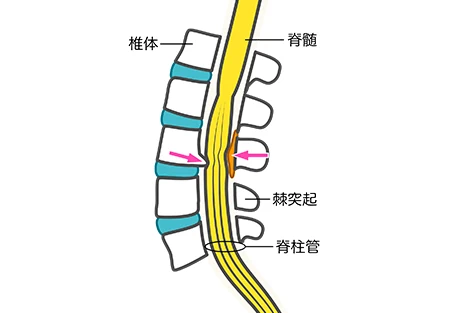 脊柱管狭窄症の説明画像