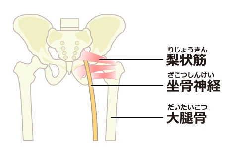 坐骨神経痛の説明画像